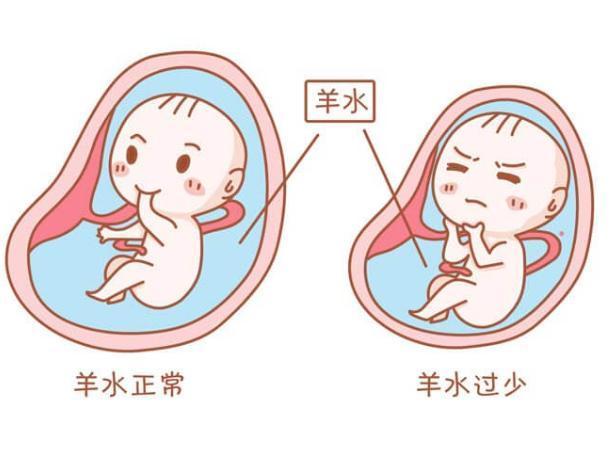 孕7个月羊水少怎么办孕7个月羊水少怎么办？全面解析与应对策略