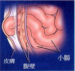 九个月宝宝疝气的原因九个月宝宝疝气的成因解析